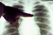 Cáncer en menores de 50: el informe que sacude a la salud internacional